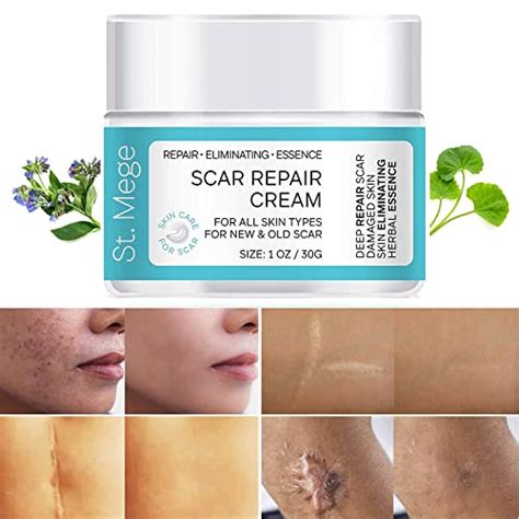 Find The Best Cream To Remove Scars Reviews & Comparison - Katynel