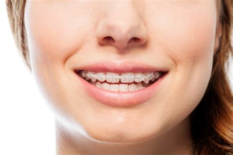 Why You Should Consider Clear Braces - Dentistry for Woodstock ...