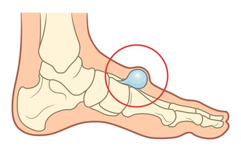 Bone Lump On Top Of Foot Clearance | emergencydentistry.com