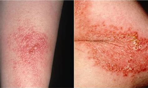 Poison Ivy Rash Treatment What Does A Poison Ivy Rash Look Like ...