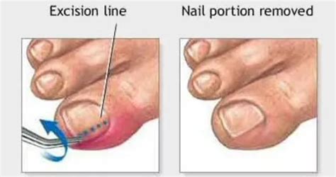 Ingrown Toenail Removal Treatment - Toronto Laser Nail