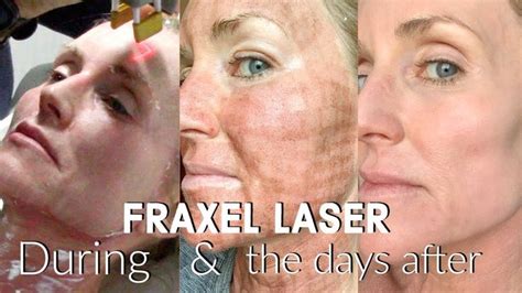 co2 laser for under eye wrinkles - pacasmallegni