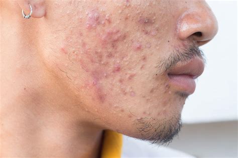 Stryx | What is Fungal Acne? Causes, Treatments, & Symptoms