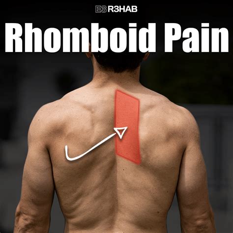 Rhomboid Pain - E3 Rehab