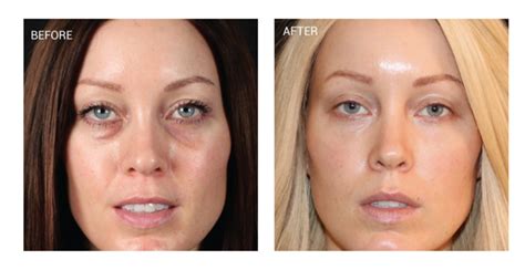 PRF Under-Eye Rejuvenation in Orlando | Gentle Touch MediSpa