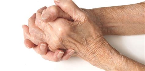 8 Warning Signs of Rheumatoid Arthritis - Page 2 of 8 - ArthritisHealth ...