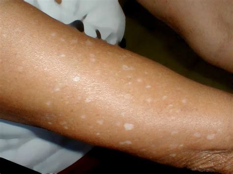 White Spots on Skin: Causes, Treatments, & Prevention