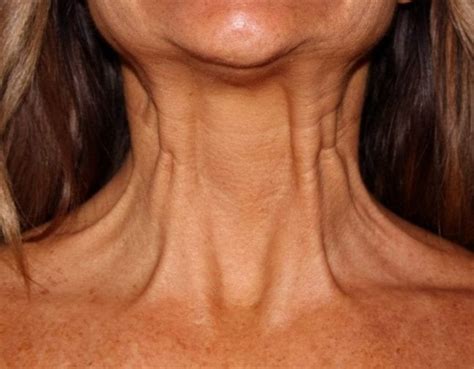 Neck Botox Before & After Photos | Rejuva Center