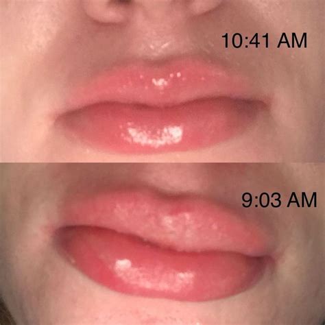 Allergic Reaction Bumps On Lips