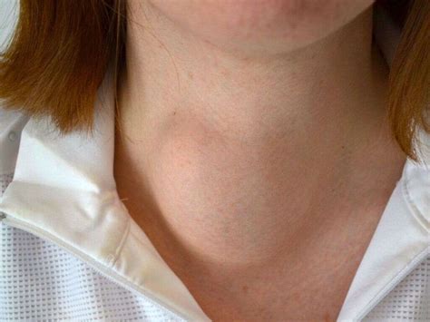 Goiter: 10 Goiter Symptoms