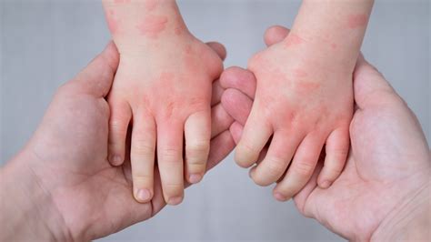 Understanding the Various Types of Hand Eczema | National Eczema ...