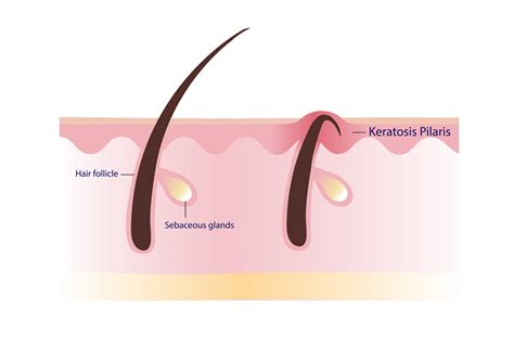 Keratosis Pilaris. Chicken skin vector illustration on white background ...