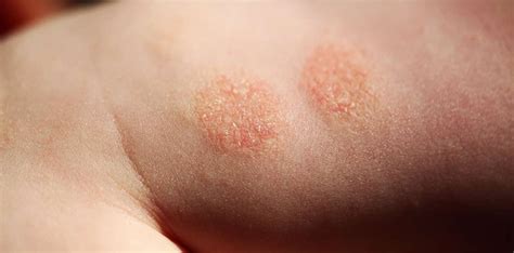 Nummular Dermatitis Causes Clear Skin Clinic