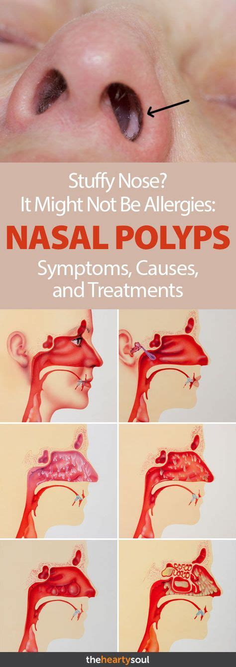 12 Best Polyps symptoms ideas | polyp, sinus polyps, sinusitis