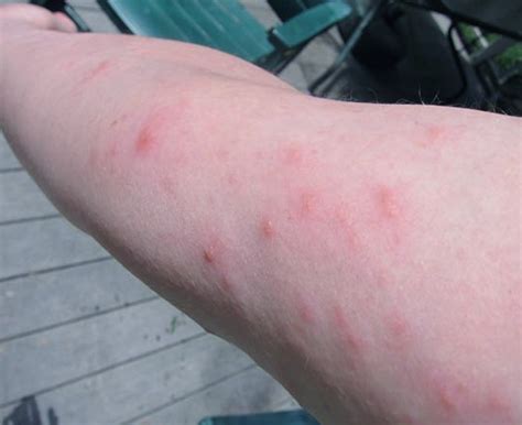 Poison Ivy Rash - Pictures, Treatment, Symptoms, Contagious, Duration