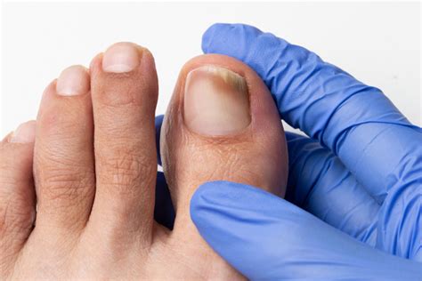 Toenail Fungus Treatment – What are my options? — FOOT & ANKLE CENTERS