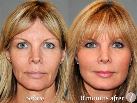 Facelift Surgery: 5 Useful and Significant facts