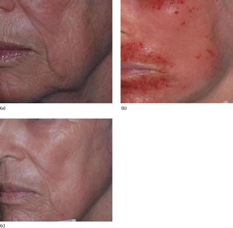 51: Ablative Laser Resurfacing: Confluent and Fractionated | Plastic ...