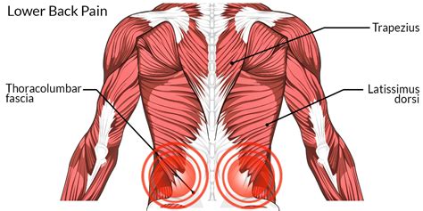 Lower Back Pain - The Complete Injury Guide - Vive Health