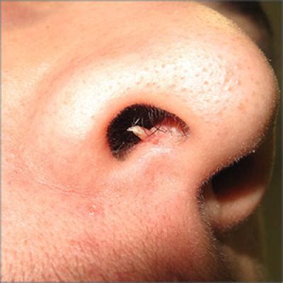 Firm and tender growth in right nostril | MDedge Family Medicine