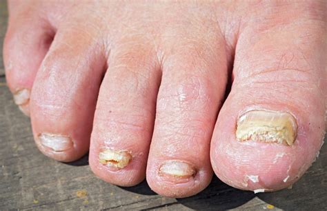 can toenail fungus cause foot pain - Toenail Fungus Treatment | Toenail ...