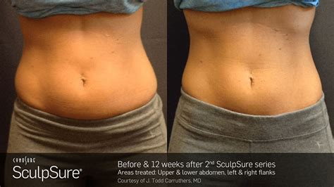 Laser Body Contouring - Before and After | SculpSure