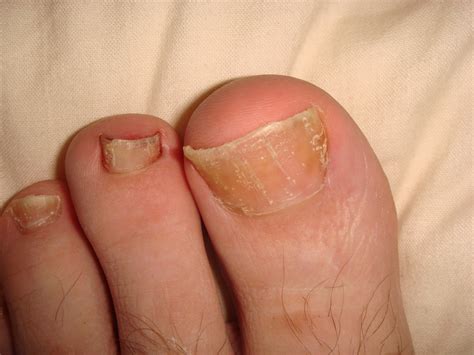 Psoriasis in the fingernails and toenails