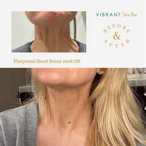 Neck Botox: The Procedure, Risks, Aftercare and Benefits - VibrantSkinBar