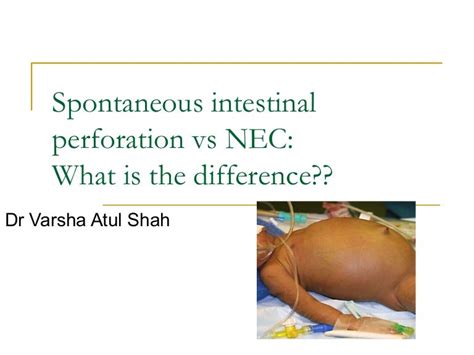 Spontaneous intestinal perforation vs nec