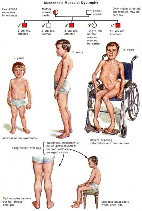 Duchenne muscular dystrophy causes, symptoms, diagnosis, treatment ...