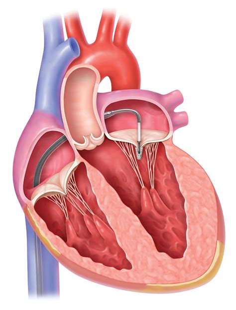 Mitral Valve: Common Diseases and Treatments | Froedtert & MCW