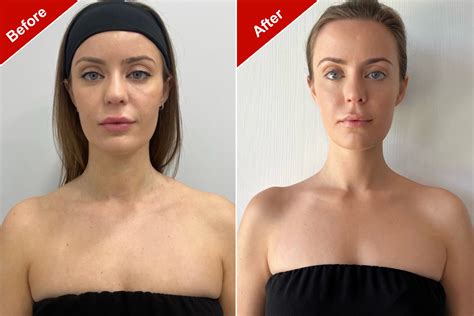 TrapTox is the latest cosmetic surgery craze on TikTok – RunwayVibes