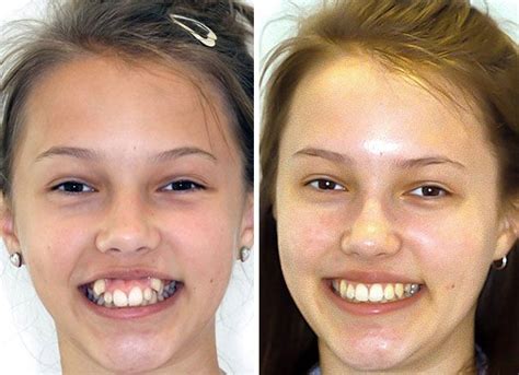 114 Incredible Before & After Transformations Of People Who Wore Braces ...