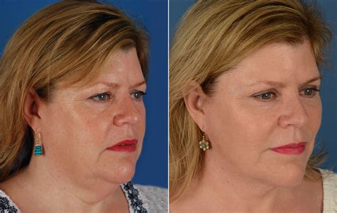 The UpLift™ Lower Face and Neck Lift Photos | Naples, FL | Patient 11683