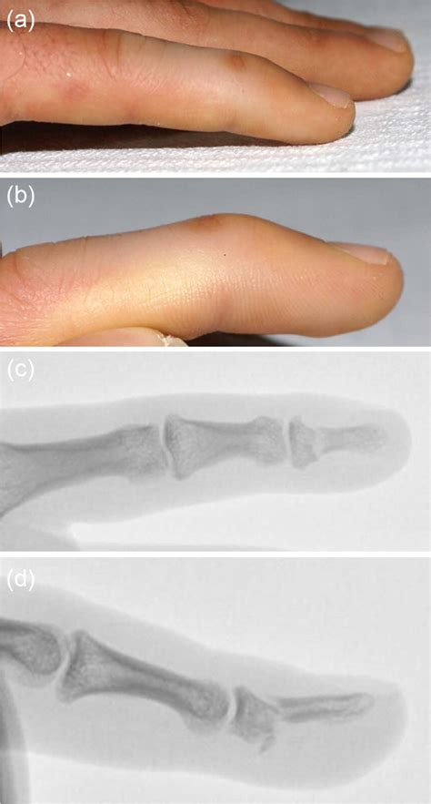 Distal Phalanx Fracture