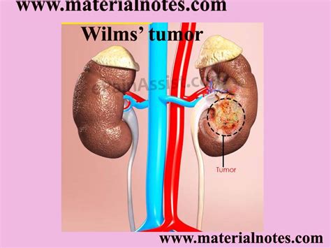 Wilms' tumour ~ Materialnotes.com- Staff Nurses in India, Nurses ...