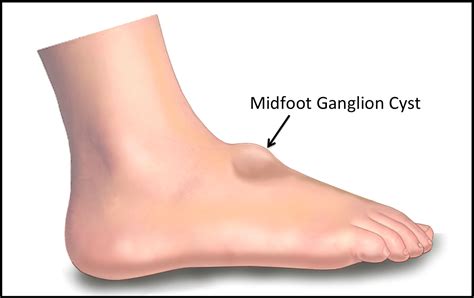 Burst Ganglion Cyst On Foot Cheap Sale | emergencydentistry.com