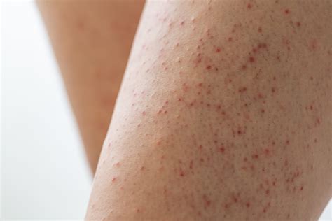 Keratosis Follicularis Legs