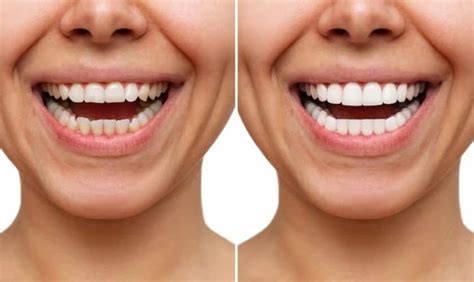 The Perfect Smile Solution - Unveiling The Power Of Veneers