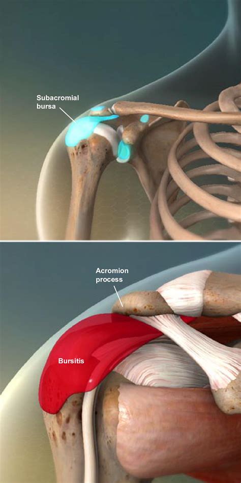 Subdeltoid Bursitis Shoulder