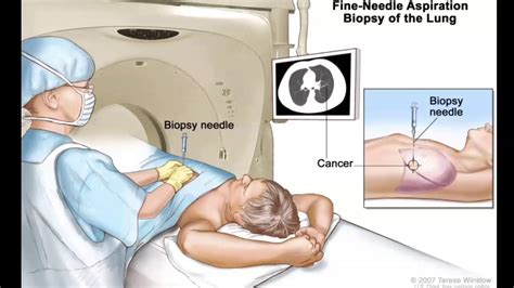 Biopsy Treatment Video | Mediastinal Biopsy | CT Guided Lung Biopsy ...