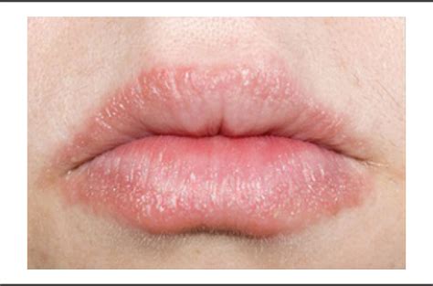 Figure 2 from Allergic Contact Cheilitis From a Variety of Lip Balm ...