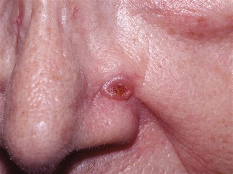 Basal Cell Carcinoma - Causes, Types, Symptoms, Prognosis, Treatment