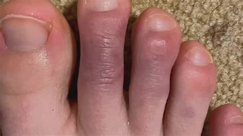 'COVID toes' are emblematic of how much is still unknown about the ...