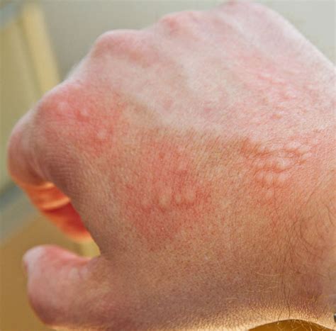 Allergic reaction on skin