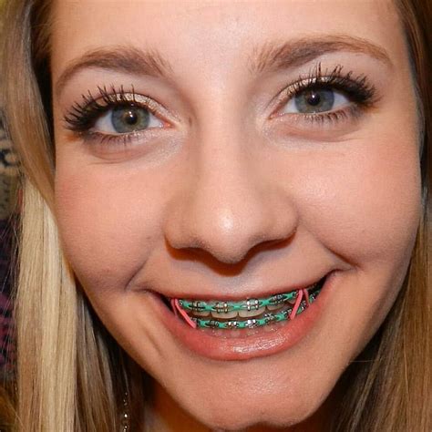 List Of What Is The Best Color To Use For Braces Ideas