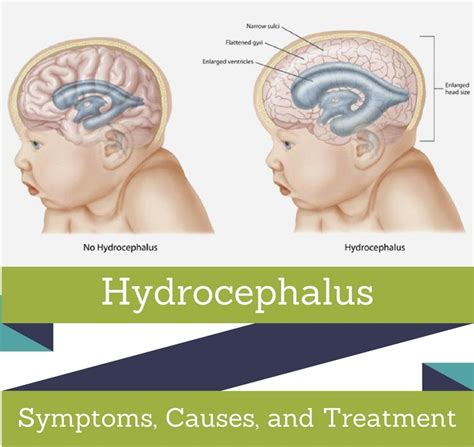 Walter's Hydrocephalus Education blog: Recovery after VP shunt implant ...