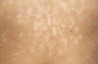 Pityriasis versicolor - HSE.ie