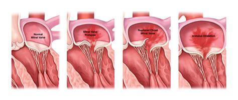 Mitral Regurgitation: A “Leaky Valve” - Gregory Koshkarian, MD, FACC