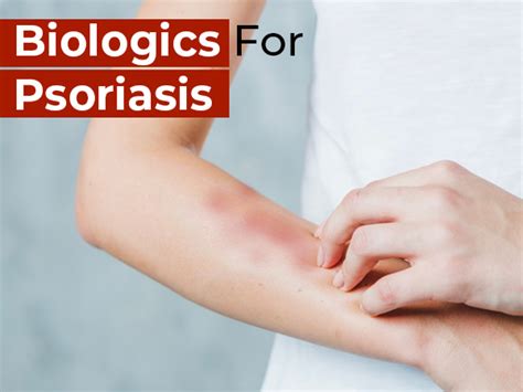 Biologics: What Are They & How They Help Treat Psoriasis - Boldsky.com